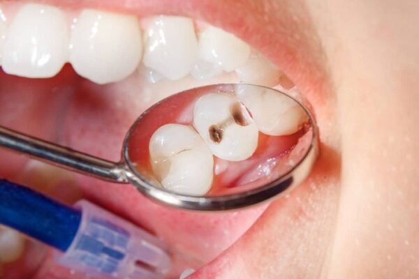 Broken Tooth Black Inside No Pain