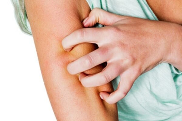 Can Detoxing Make You Itch