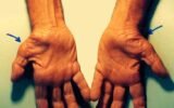 Carpal Tunnel Syndrome