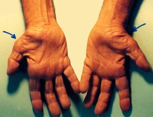 Carpal Tunnel Syndrome