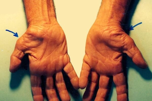 Carpal Tunnel Syndrome