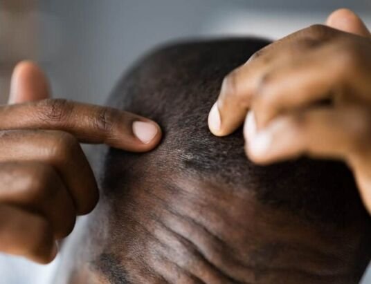 Does Durag Cause Hair Loss