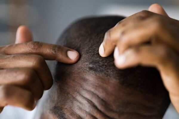 Does Durag Cause Hair Loss
