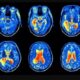 Radiologist vs Neurologist: Who to Consult for Your Brain Imaging Needs?
