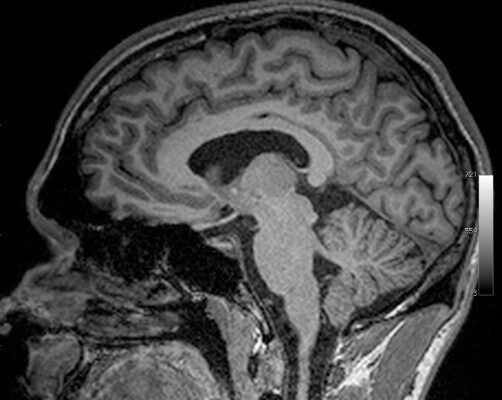 How to Repair White Matter in the Brain
