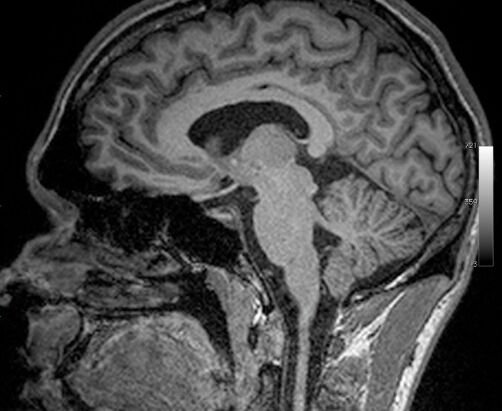 How to Repair White Matter in the Brain