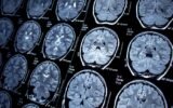 MRI Coils Market Surges to New Heights Amid Growing Demand for Medical Imaging