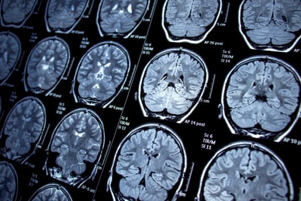 MRI Coils Market Surges to New Heights Amid Growing Demand for Medical Imaging
