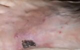 boiling water prank injury recovery