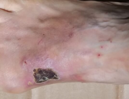 boiling water prank injury recovery