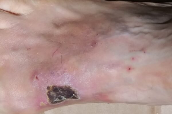 boiling water prank injury recovery