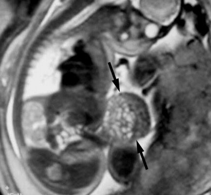 pregnancy brain changes MRI scan