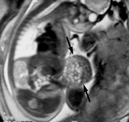 pregnancy brain changes MRI scan