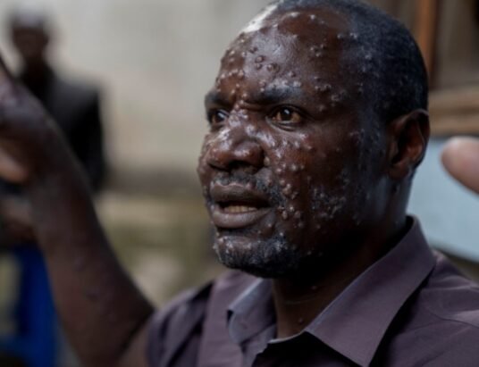 Congo disease outbreak WHO investigation