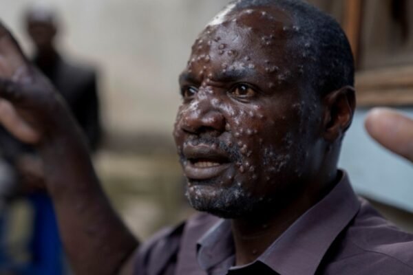 Congo disease outbreak WHO investigation