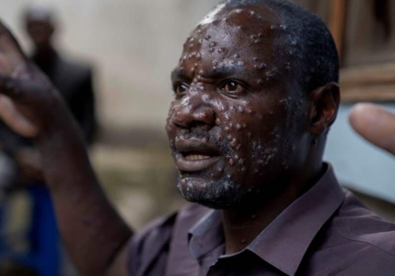 Congo disease outbreak WHO investigation
