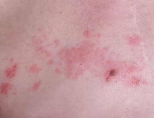 shingles virus awareness campaign