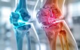 arthritis joint pain young adults