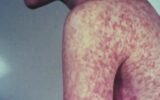 measles outbreak USA