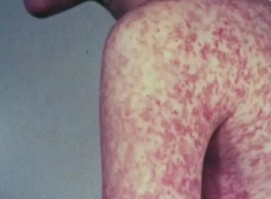 measles outbreak USA