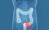 colon cancer exercise recovery treatment
