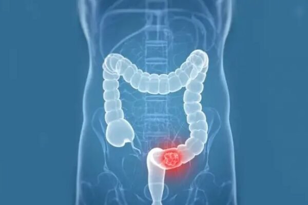 colon cancer exercise recovery treatment