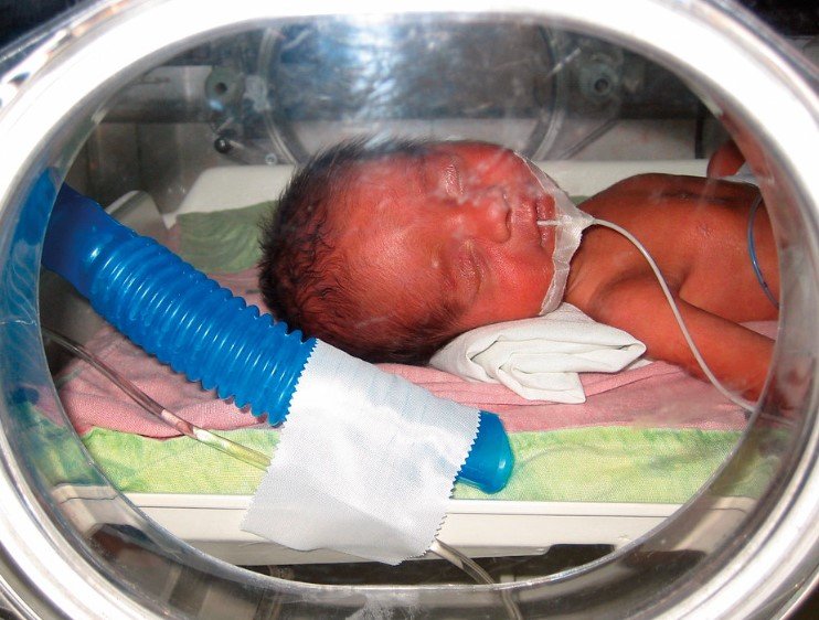 premature baby in neonatal intensive care unit