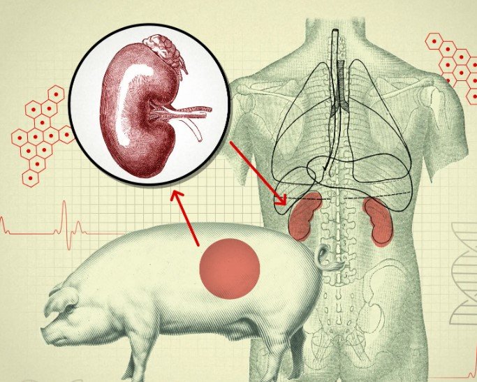 pig lung transplant