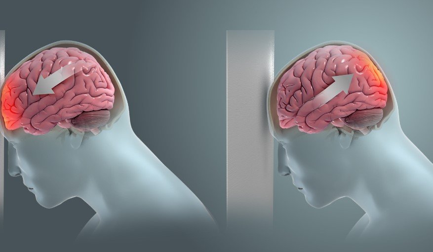 brain injury illustration
