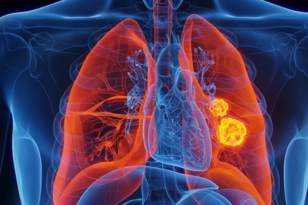 lung cancer research
