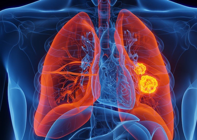 lung cancer research