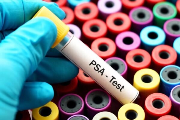 prostate cancer screening