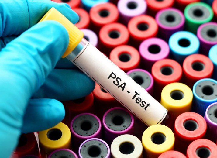 prostate cancer screening