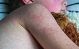measles rash infant coastal georgia