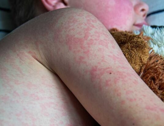 measles rash infant coastal georgia