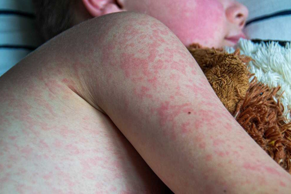 measles rash infant coastal georgia
