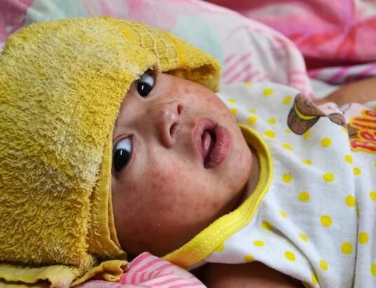 measles rash infant symptoms