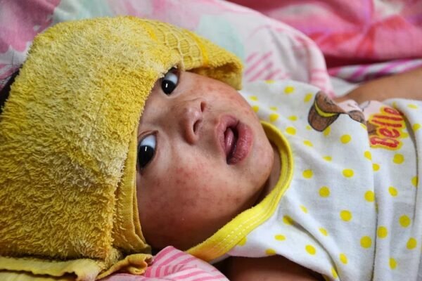 measles rash infant symptoms