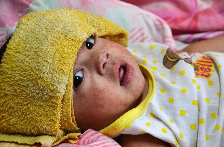 measles rash infant symptoms