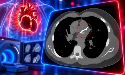 CorCal calcium CT versus statin risk equation