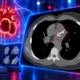 CorCal calcium CT versus statin risk equation